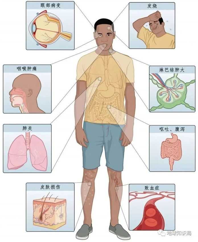 極少數情況下還會引發敗血症（圖：CDC）